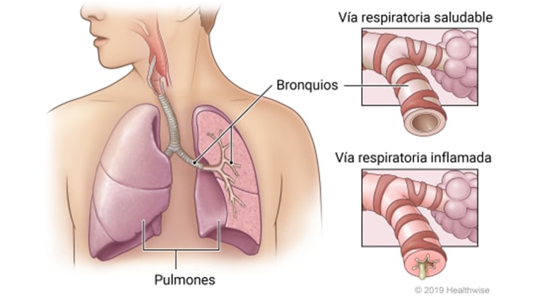 Fondo de Bronquitis crónica
