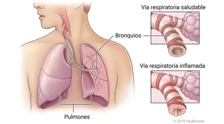 Bronquitis crónica