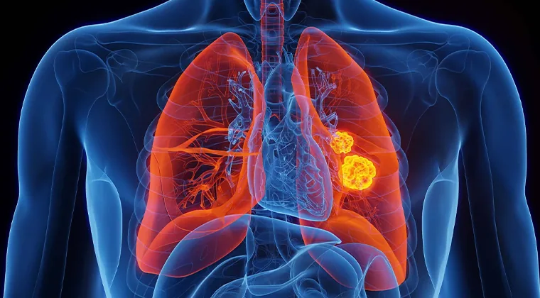 Cáncer de pulmón