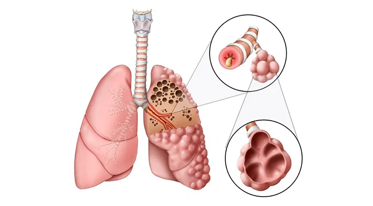 Enfermedad pulmonar obstructiva crónica (EPOC)