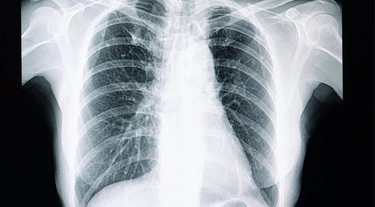 Fibrosis pulmonar