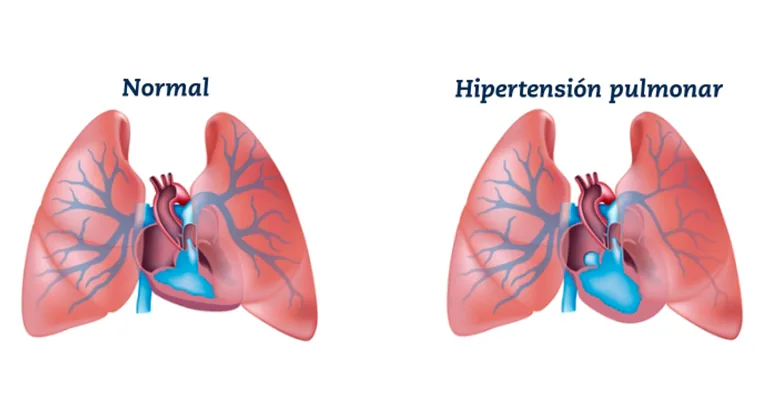 Hipertensión pulmonar