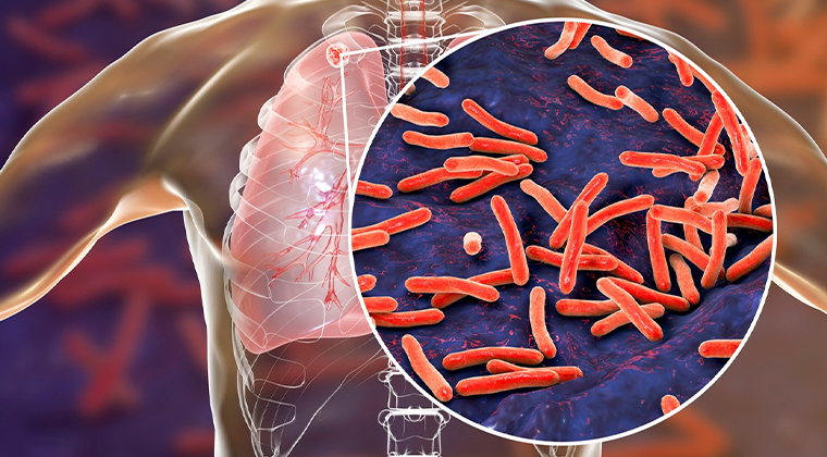 Fondo de Tuberculosis pulmonar