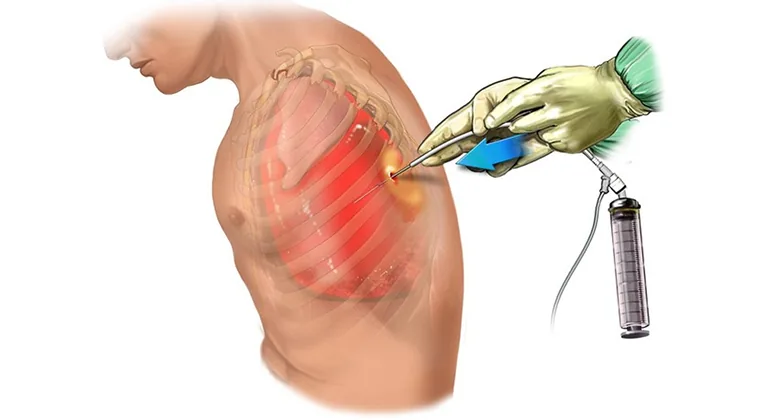 Toracocentesis